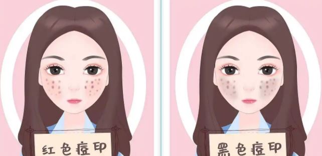 臉上紅色痘印幾個(gè)月都不消怎么辦？紅色痘印應(yīng)該怎么消除？