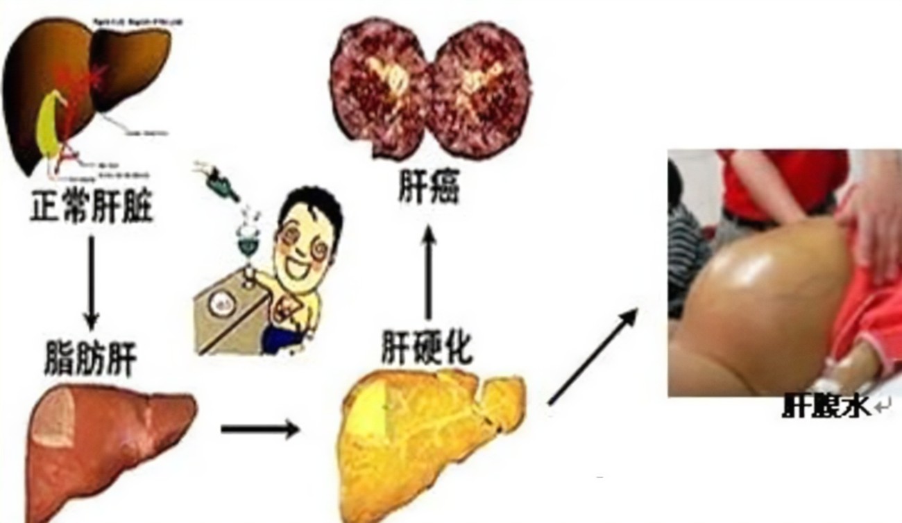 查出肝硬化還有救嗎？