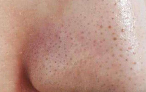 清潔面膜哪個(gè)牌子可以快速祛黑頭？趙薇、薇婭 推薦的紐西之謎泥膜真的好用嗎？